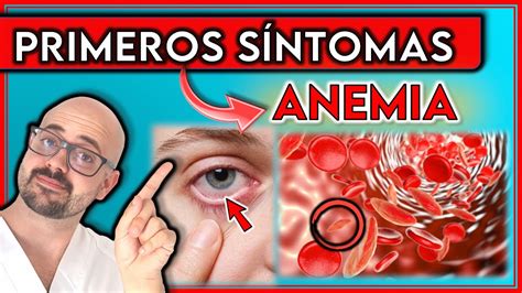 sintomas de la anemia - pure de abobora cabotia